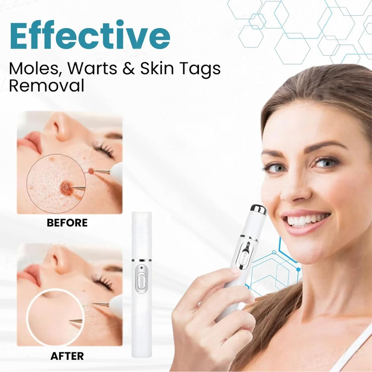 Non-Invasive Mole & Wart Removal Laser Pen – Portable Skin Spot Care Device